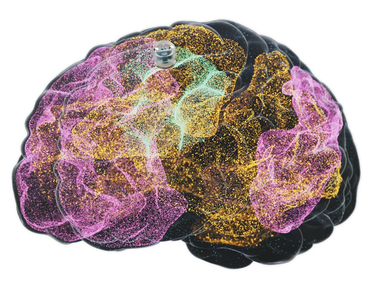 A Brain Implant for Depression Is About to Be Tested in Humans