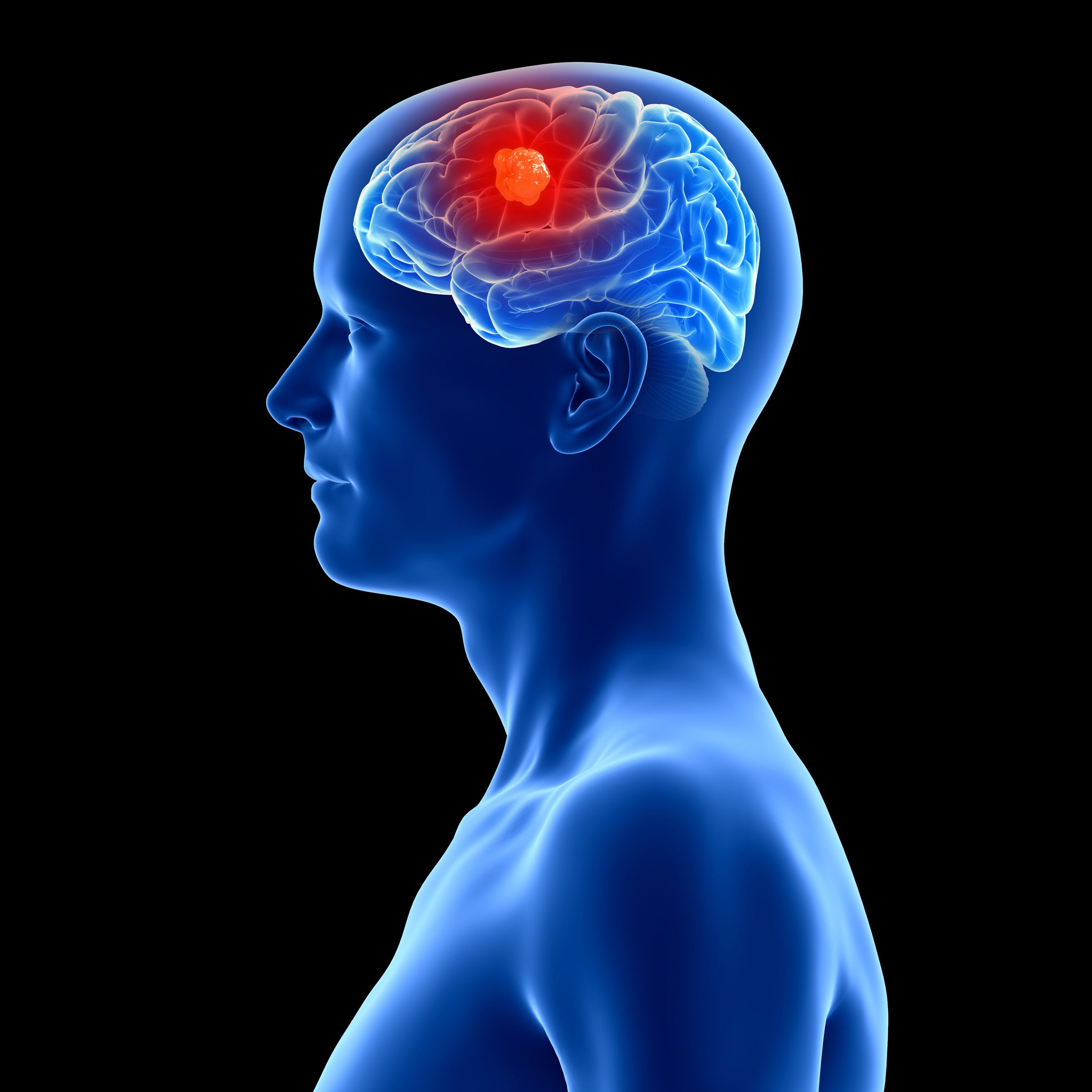 3 People Have Gotten Cancer-Detecting Implants in Their Brains